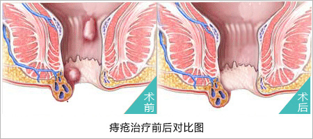 內痔術前與術后對比圖